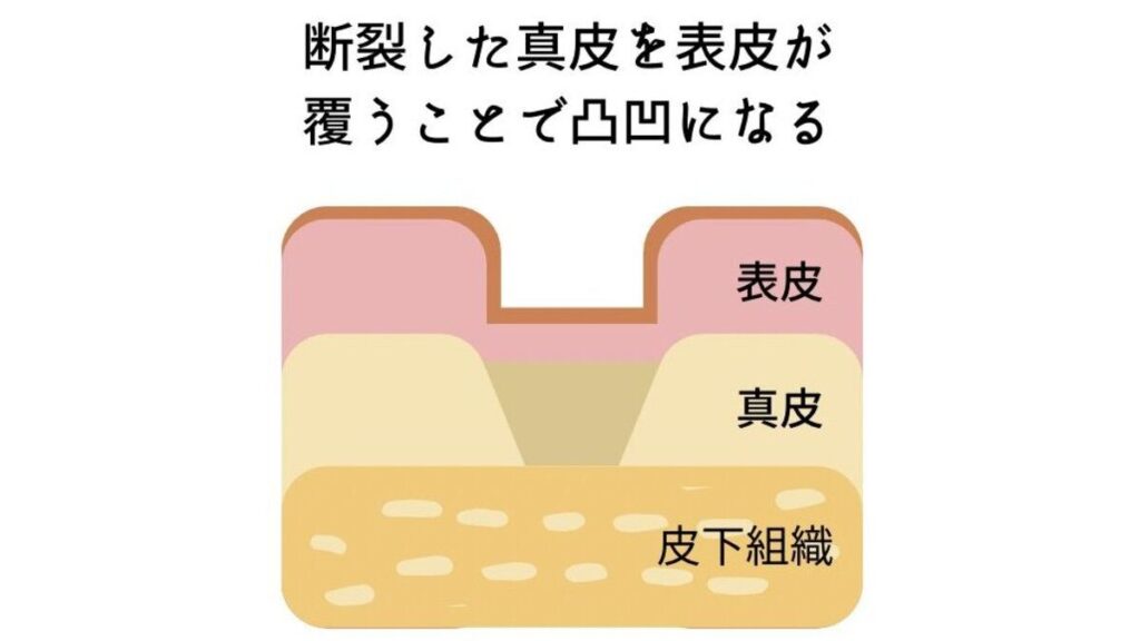 肉割れができた皮膚の断面図