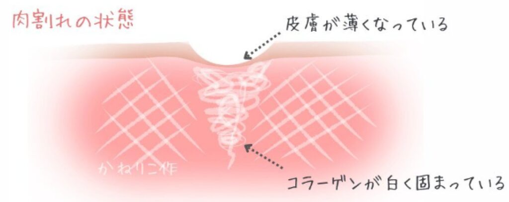 肉割れの状態の肌