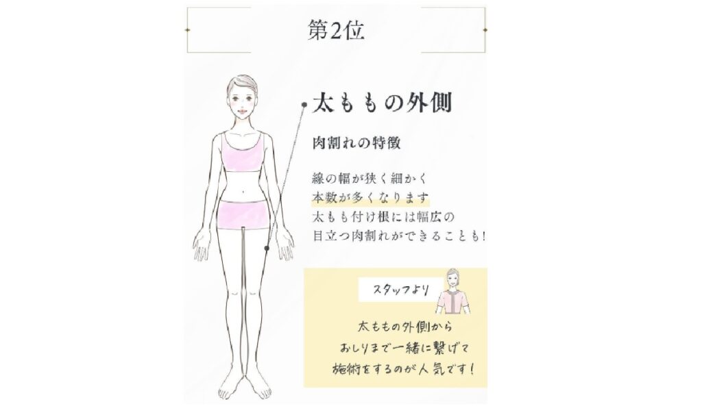 ヴェルスカー施術2位太ももの外側