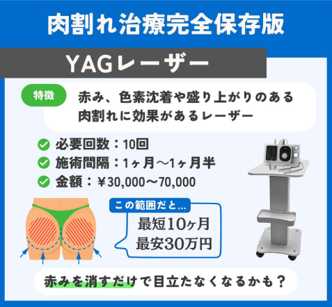 YAGレーザー施術の特徴