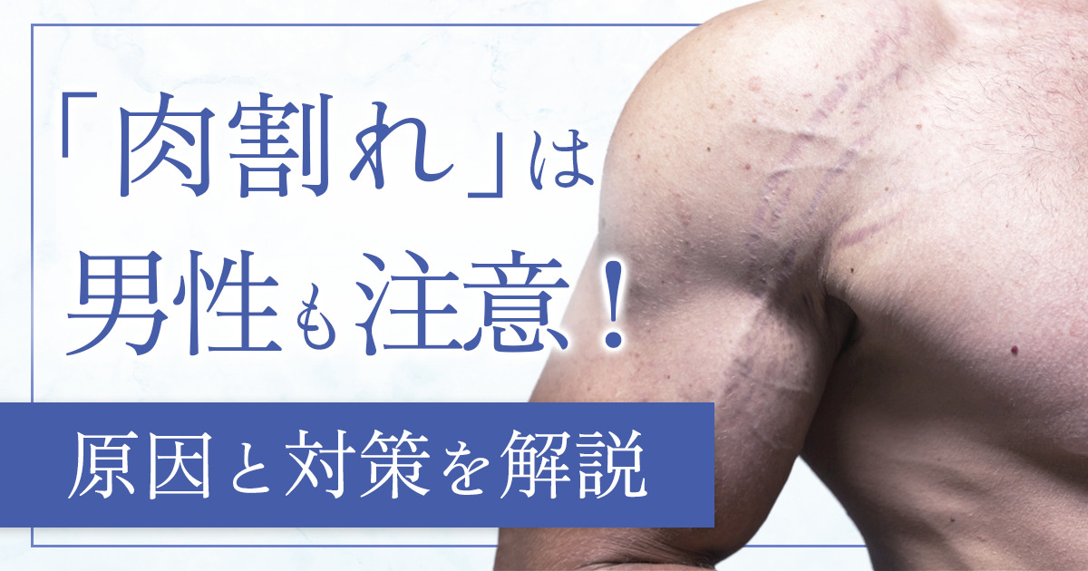 肉割れは男性にもできる！よくある原因と起こりやすい部位・治し方を解説