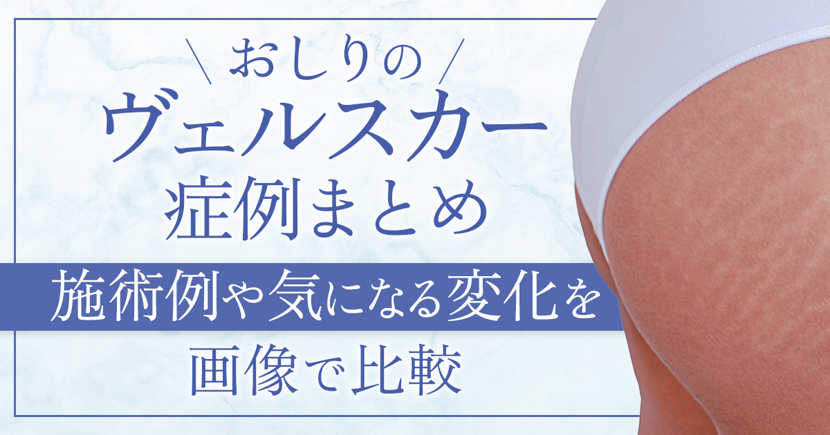 お尻のヴェルスカー症例写真