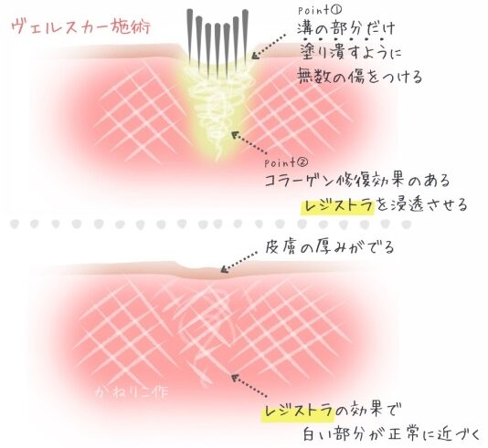 ヴェルスカーの施術の特徴