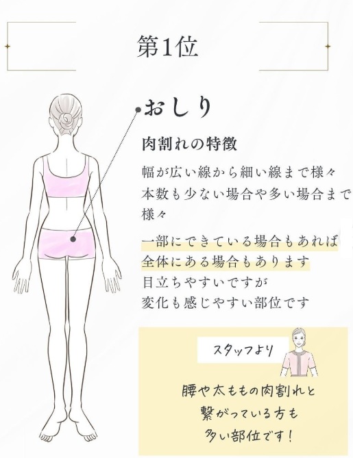 ヴェルスカー施術人気1位おしり
