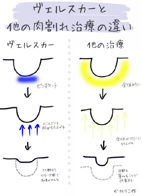 ヴェルスカーと他の肉割れ治療の違い