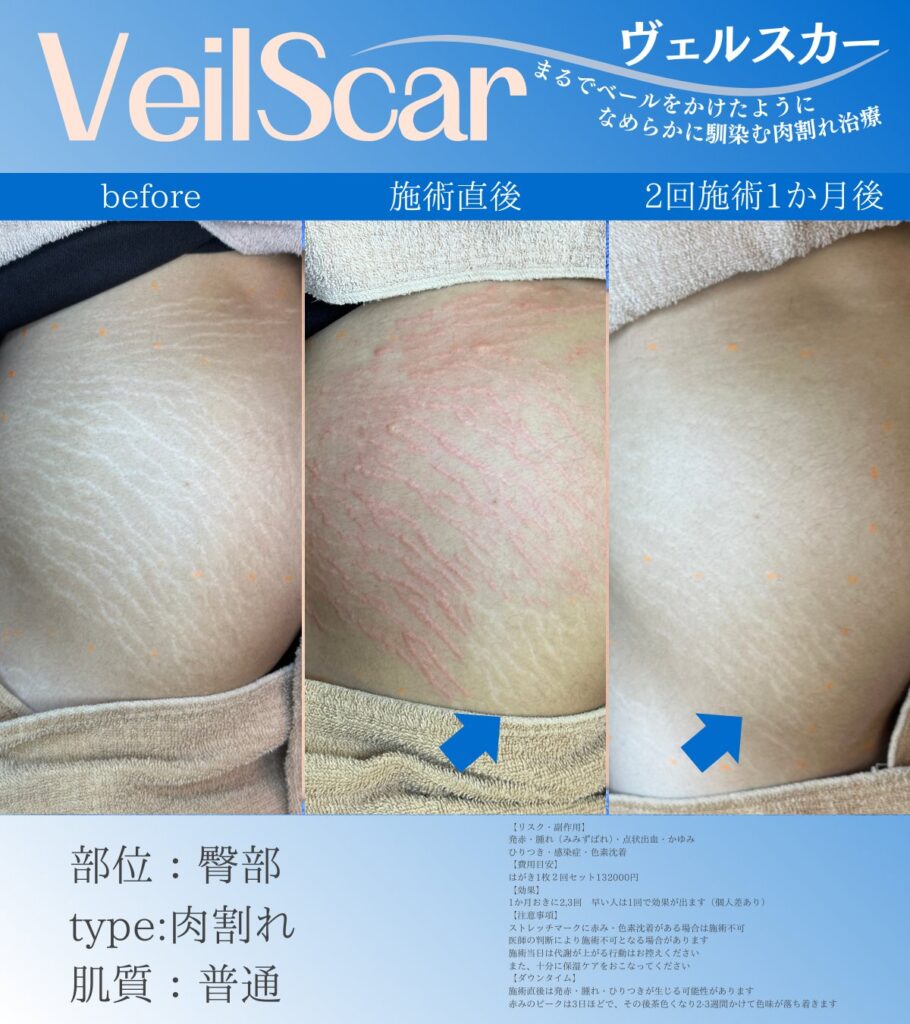 赤みの症例画像