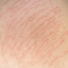 当日から1週間後の肌