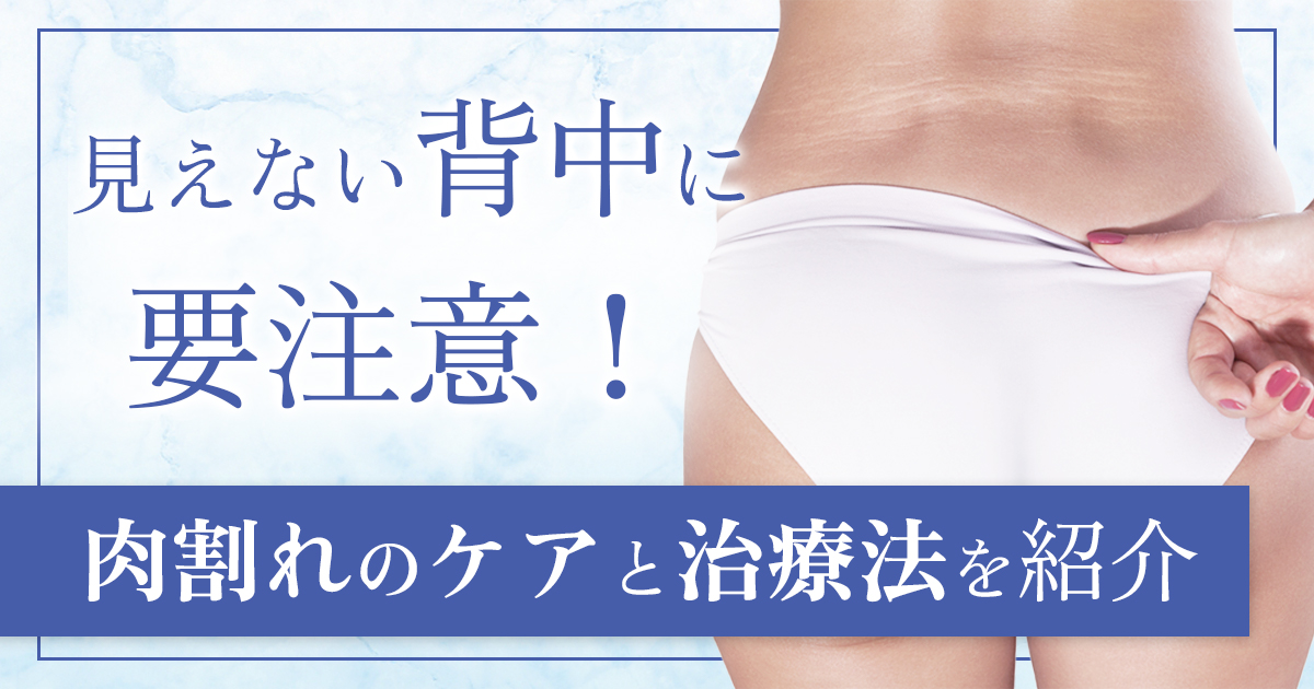 背中の肉割れの特徴とは？5つの発生原因と改善・予防方法を解説