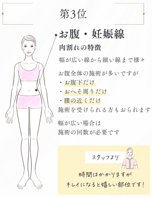 ヴェルスカーの施術3位お腹と妊娠線