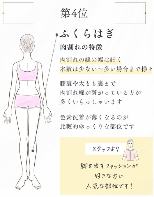 ヴェルスカーの施術4位ふくらはぎ