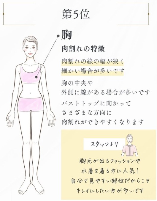 ヴェルスカーの施術5位胸