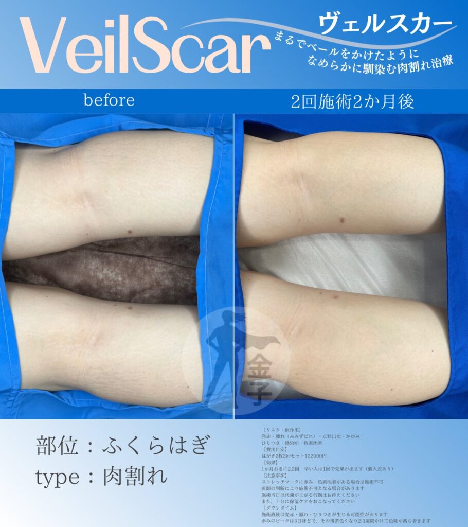 ふくらはぎの肉割れ症例1