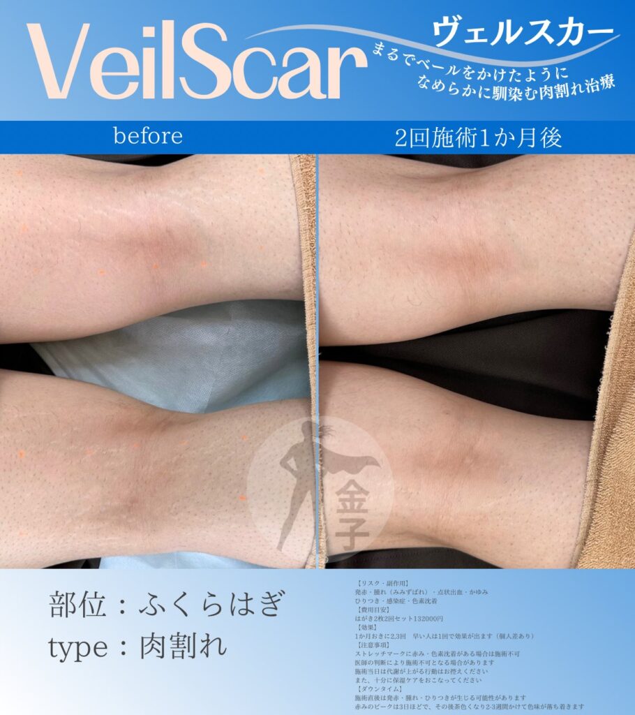 膝のヴェルスカー症例画像男性