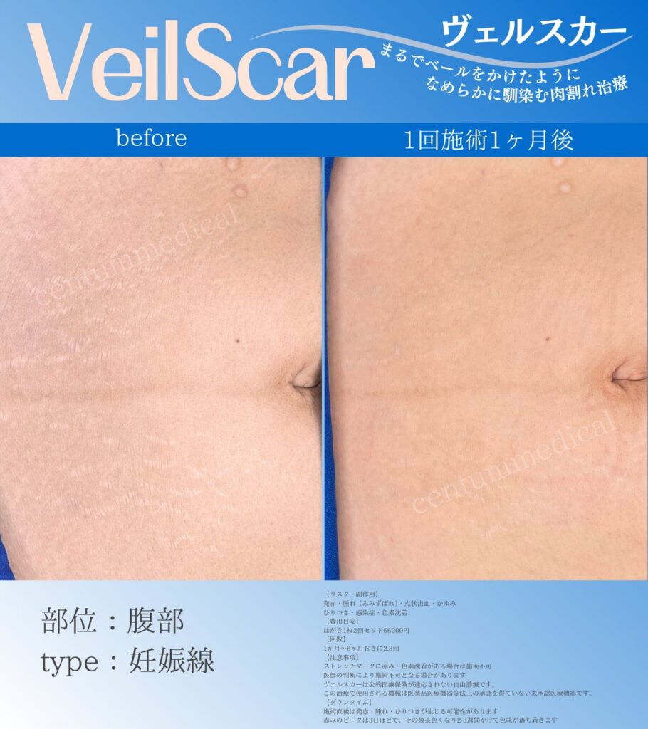 ヴェルスカーお腹の肉割れ症例画像