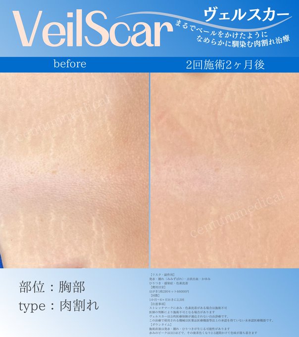 胸のヴェルスカー症例画像