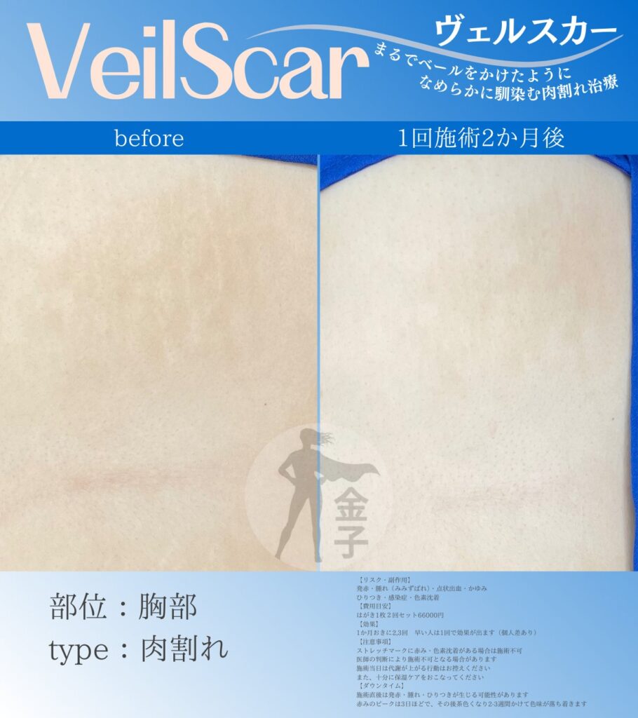 ヴェルスカー胸の症例画像