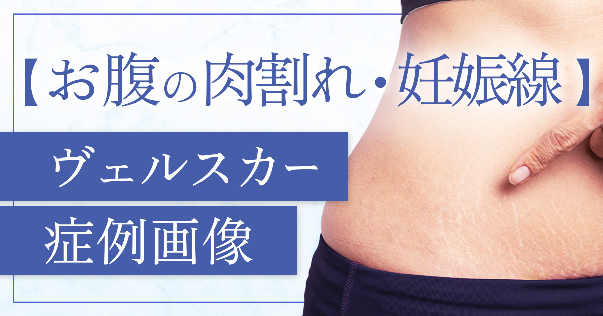 【お腹・妊娠線】のヴェルスカー症例画像を紹介