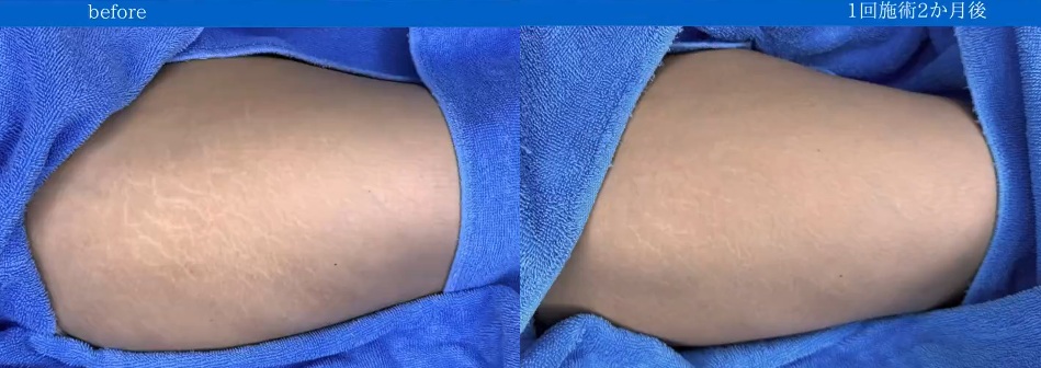 脱毛後の太ももの肉割れ