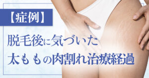 【症例2】脱毛後に気づいた太ももの肉割れ ヴェルスカーによる治療経過