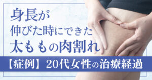 【症例3】思春期の頃、身長が伸びた時にできた太ももの肉割れ ― 20代女性の治療経過