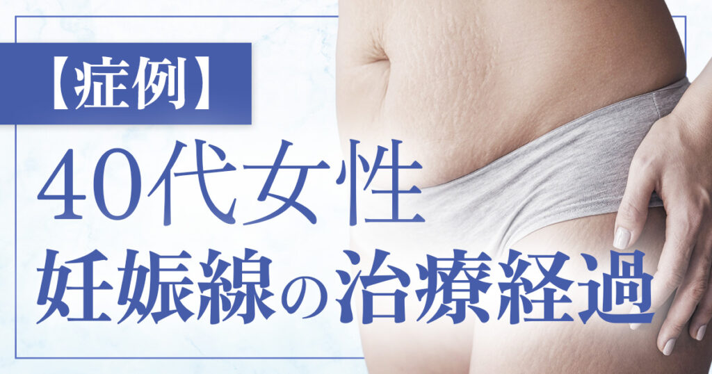 【症例4】40代女性／腹部の妊娠線に対する治療ケース