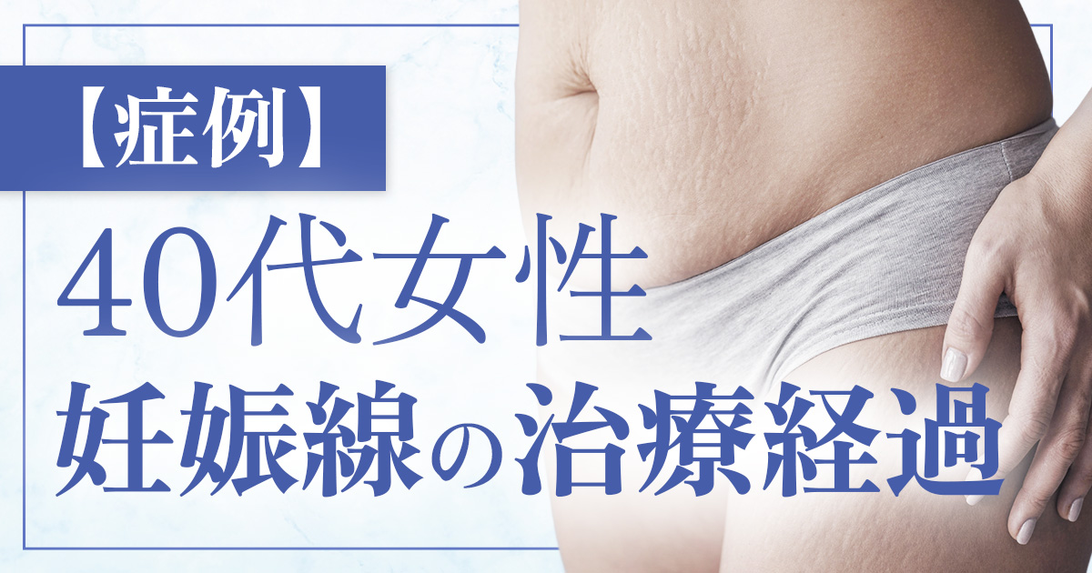 【症例4】40代女性／腹部の妊娠線に対する治療ケース