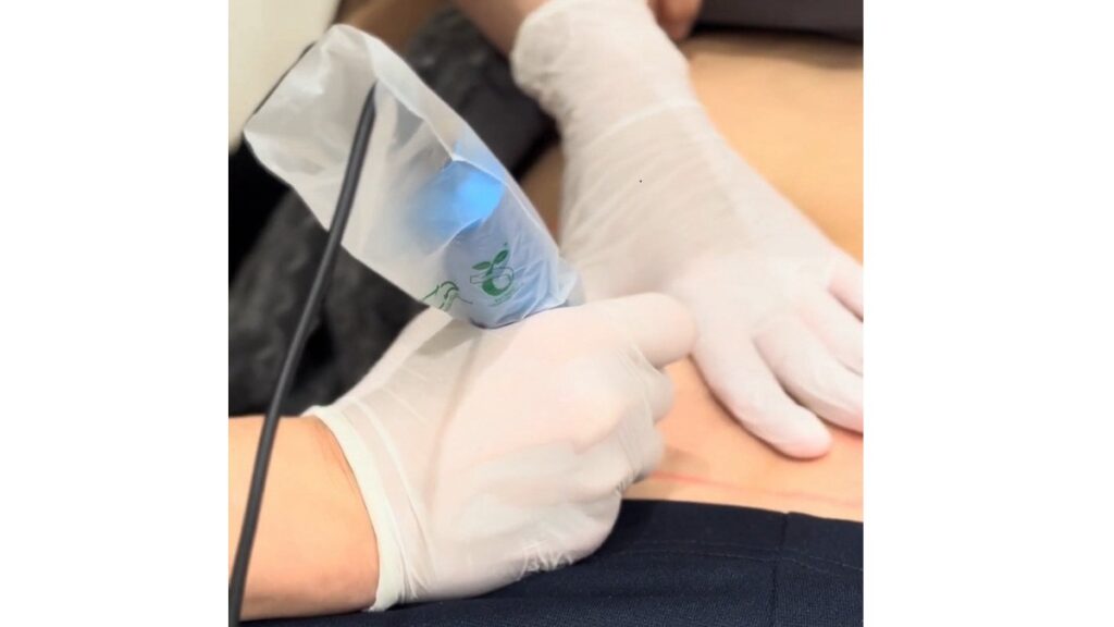 肉割れ治療ヴェルスカー