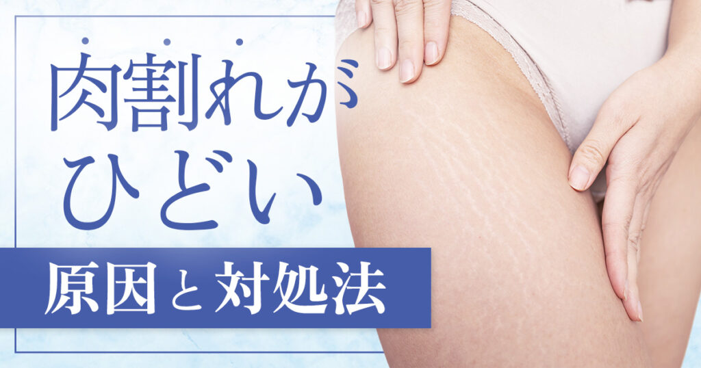 肉割れがひどいのはなぜ？原因と対処法・治療で改善を目指す方法