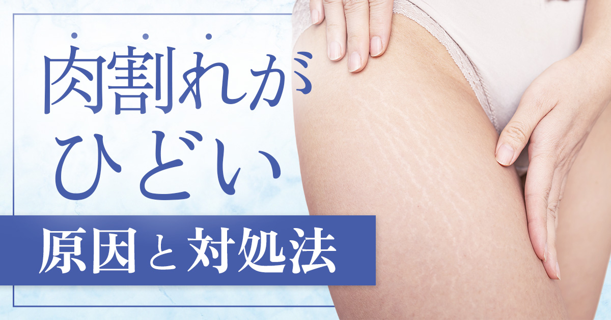 肉割れがひどいのはなぜ?原因と対処法・治療で改善を目指す方法