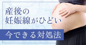 産後の妊娠線がひどい…どうしたらいい？原因とケア方法、治療の選択肢まで解説