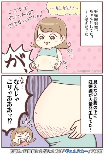 お腹の下の妊娠線