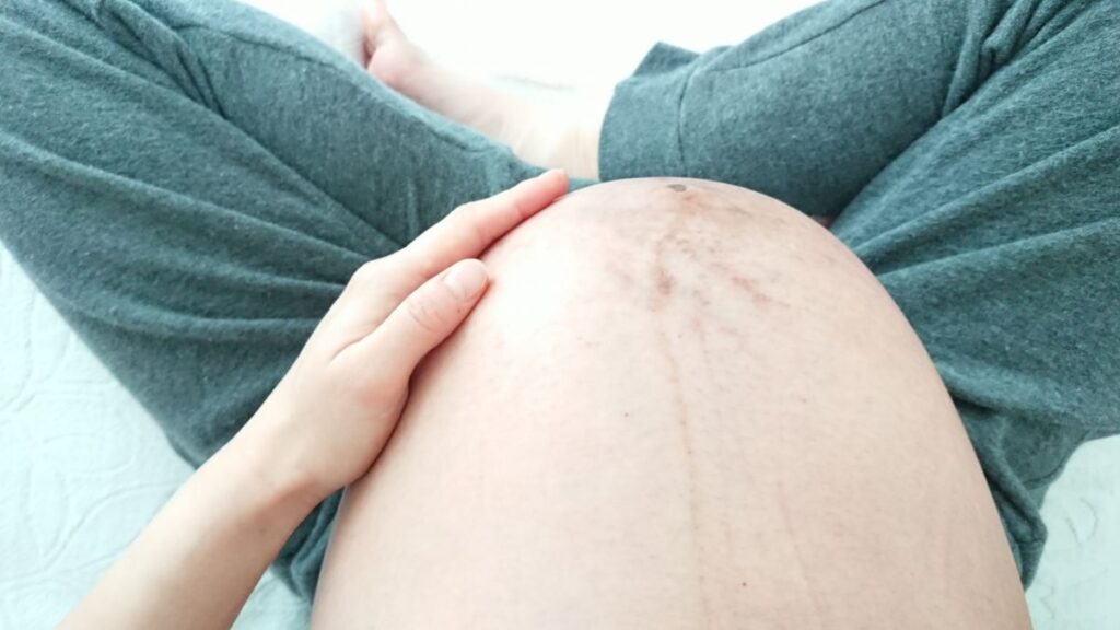 妊娠線ができたお腹