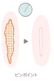 ヴェルスカーの範囲