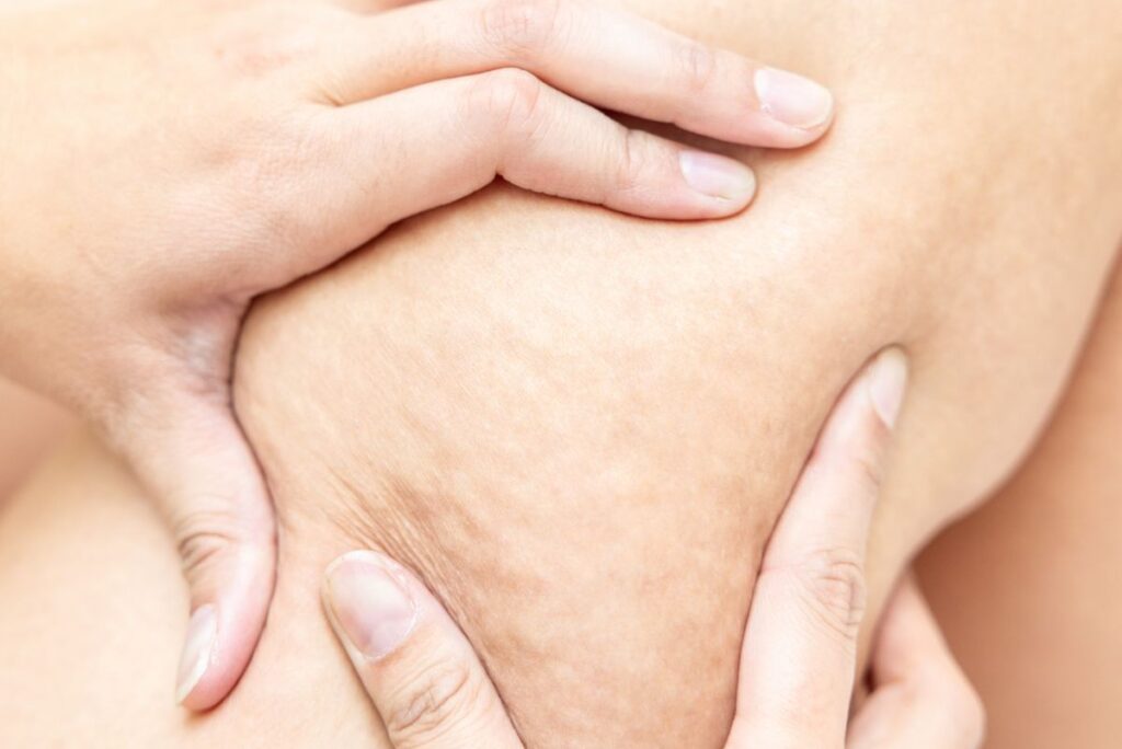 セルライトのある肌