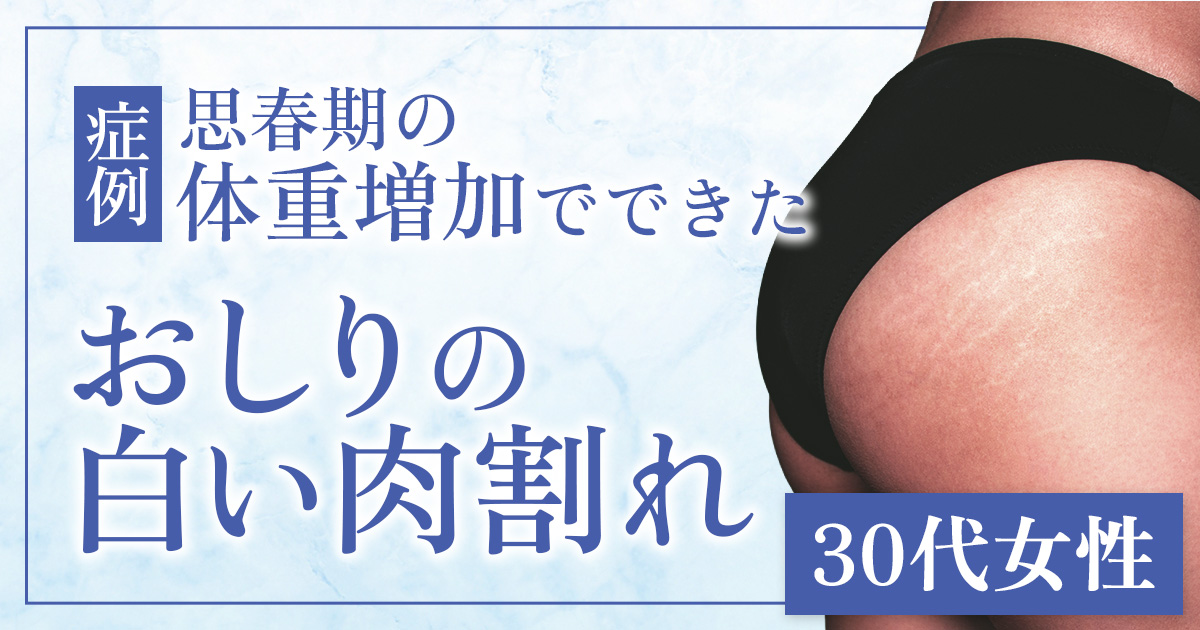 【おしり〜太もも症例】思春期の体重増加でできた白い肉割れ 30代女性