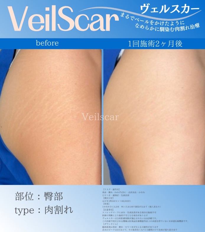 30代女性のおしりの肉割れ