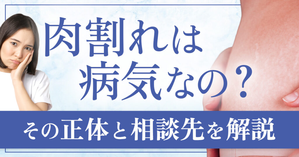 肉割れは病気？ストレッチマークの原因と相談先も解説