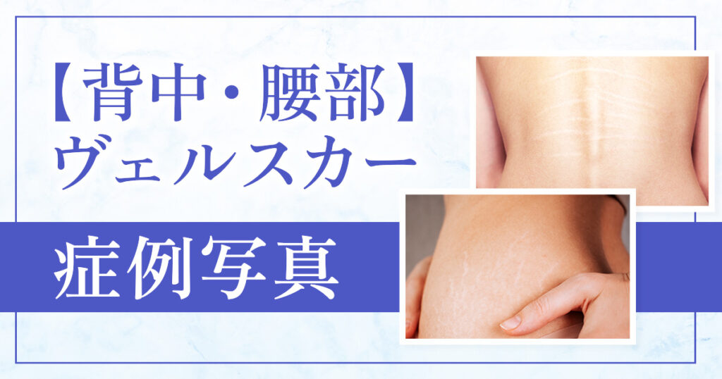 【ヴェルスカー背中・腰部】の施術、症例写真