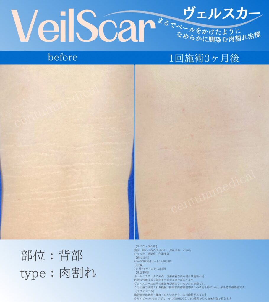 男性患者、背中の肉割れヴェルスカー