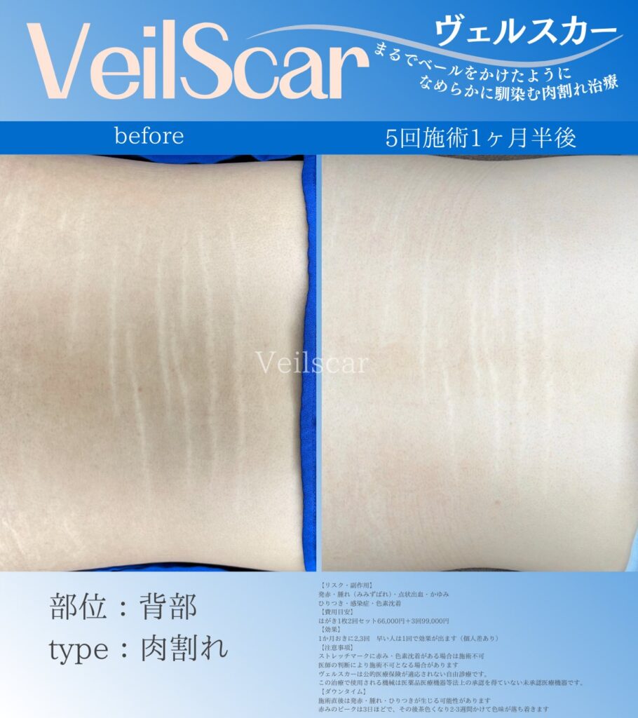 女性患者様背中の肉割れ