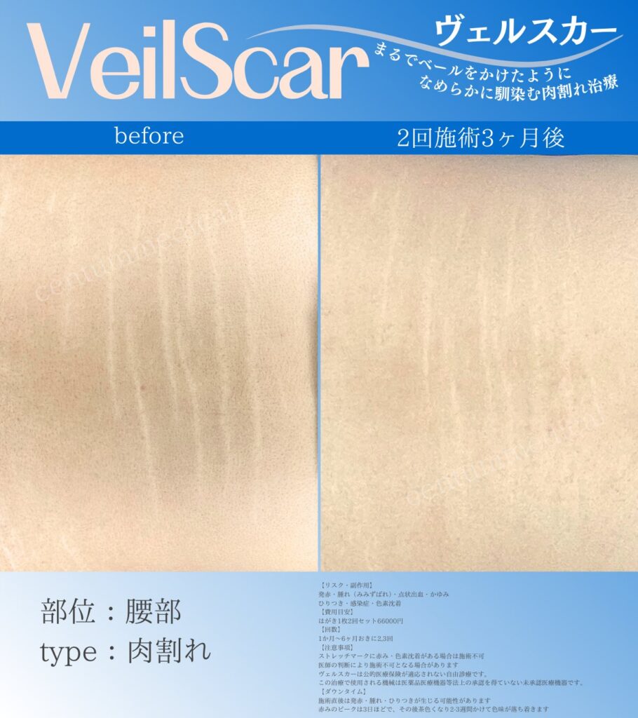 背中（腰）の肉割れの2回施術後