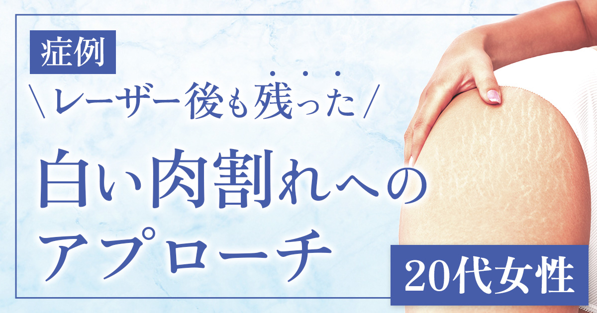 【症例】炭酸ガスレーザー約20回後も残った…白い肉割れへの治療（20代女性）