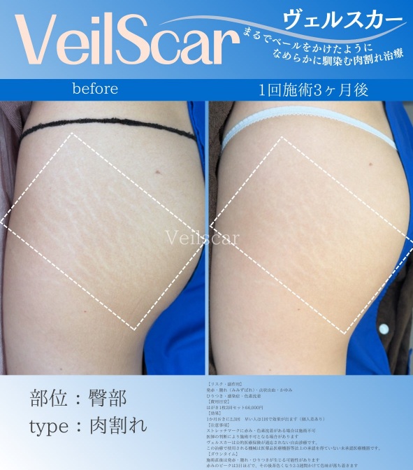 レーザー治療後の20代女性の患者様