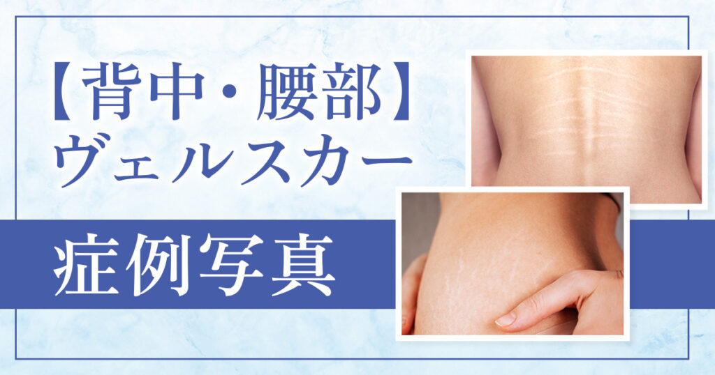 【ヴェルスカー背中・腰部】の施術、症例写真