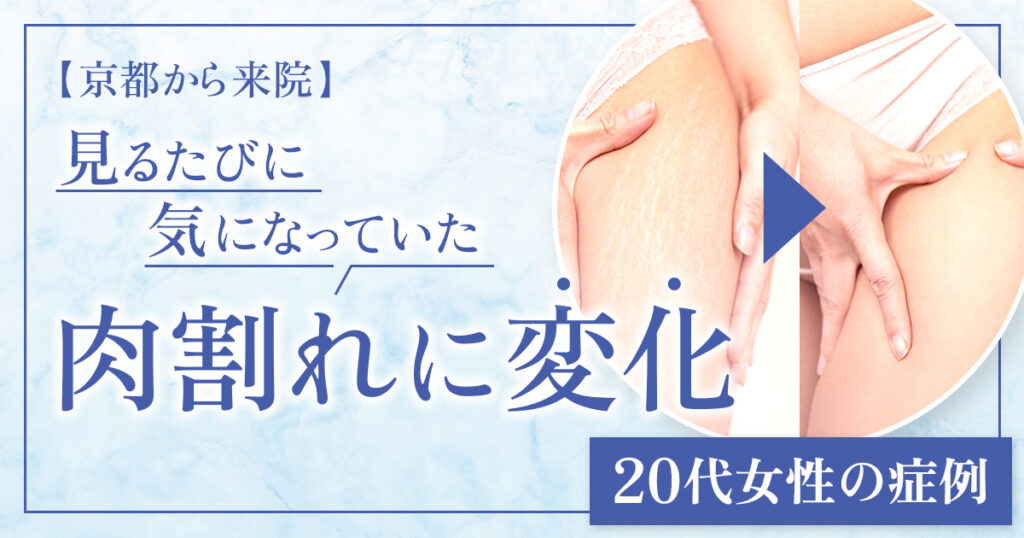 【症例】京都から来院、長年のコンプレックスだった肉割れ治療 -20代女性-