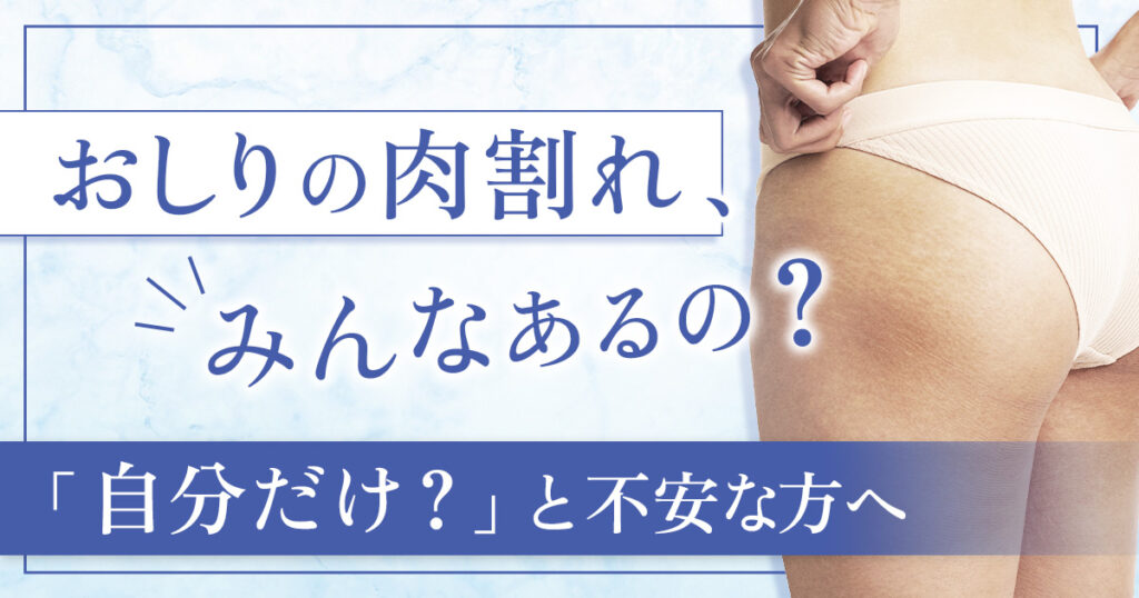 おしりの肉割れはみんなある？「自分だけ？」と不安な方へ