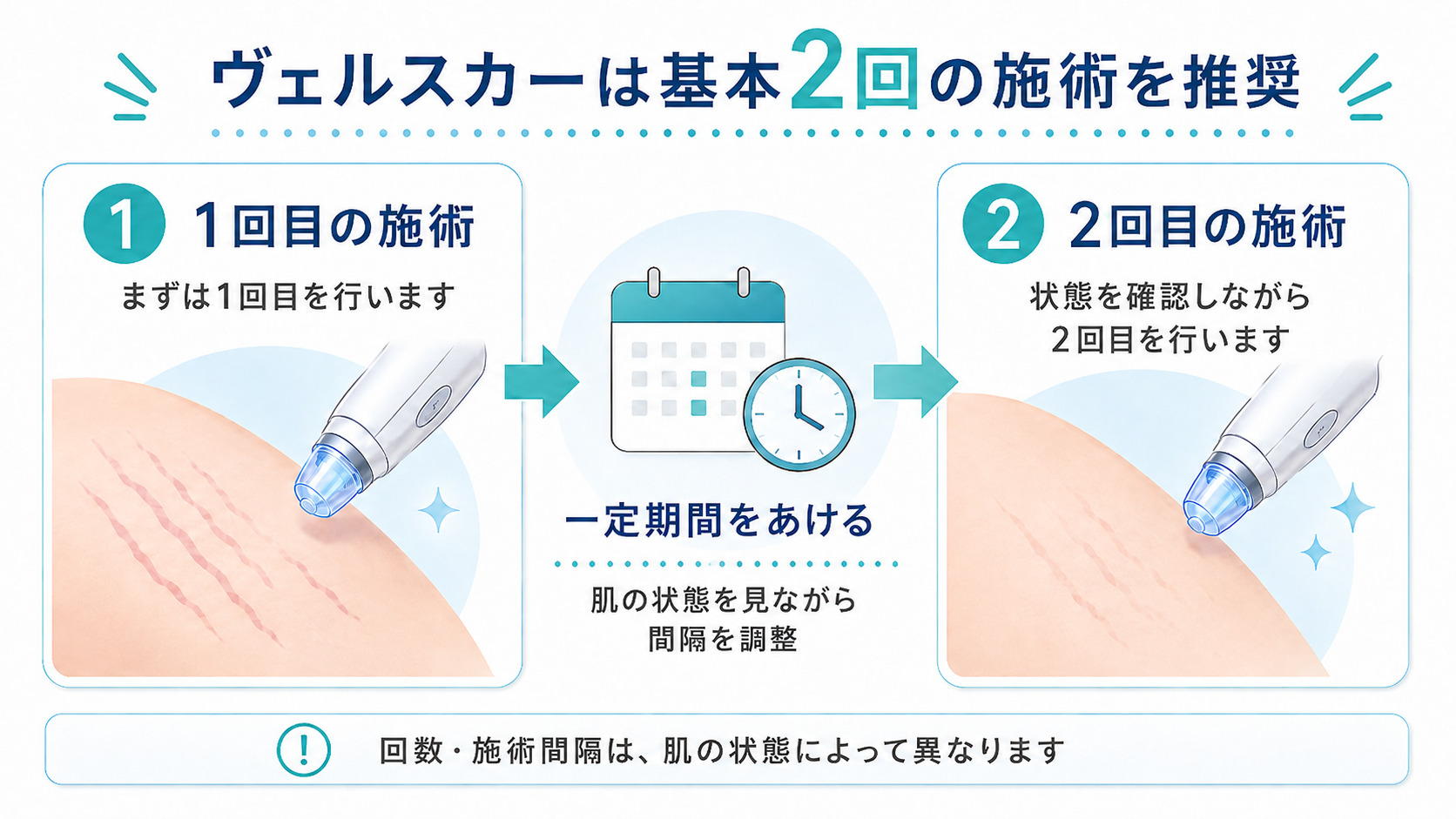 ヴェルスカーは2回の施術を前提